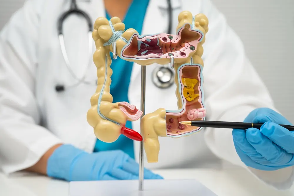 Especialista explica enfermedades del colon con un modelo anatómico